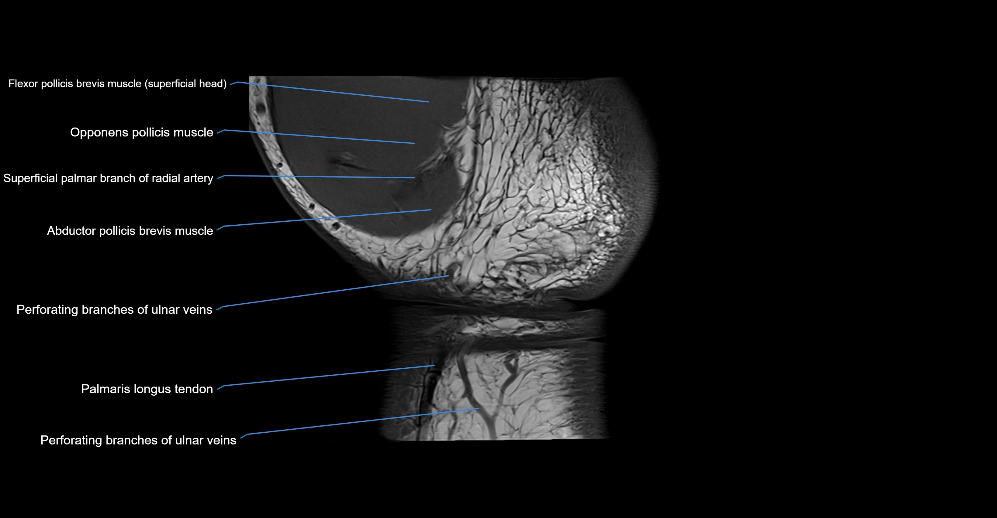 MRI wrist coronal cross sectional anatomy 3T  radiology  image-img-00001-00025.webp